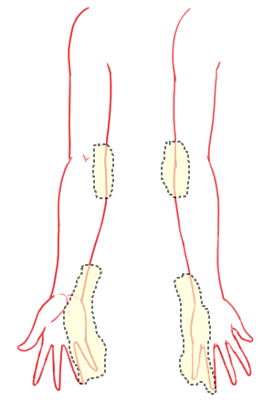 肘部管症候群の症状域の図
